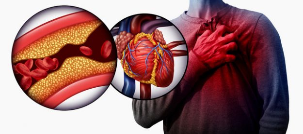 Срцев удар Срцеви болести
