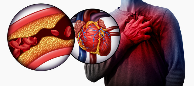 Срцев удар Срцеви болести
