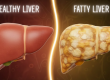 How to reverse fatty liver