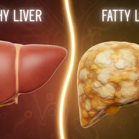 How to reverse fatty liver