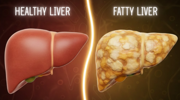 How to reverse fatty liver